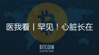 医我看丨罕见！心脏长在右胸膛！珠海成功开展首例“右位心”房颤射频消融术